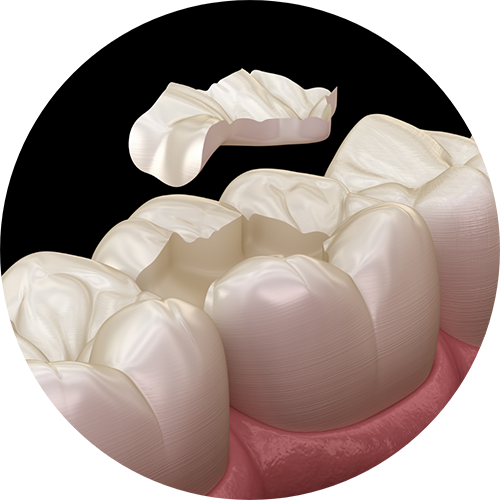 Illustration of a dental inlay restoring a chipped tooth