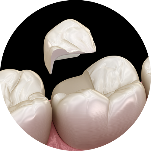 Illustration of a dental onlay restoring a broken tooth